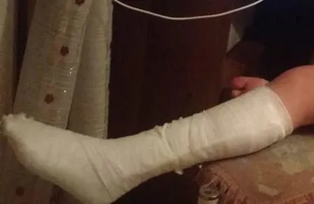 Сломала ногу на качели несовершеннолетняя в Биробиджане